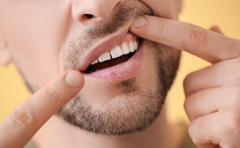 Diş əti qaşınmasının