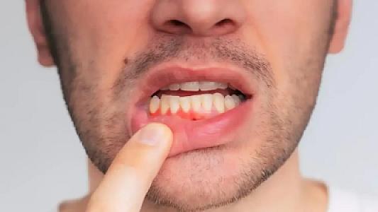 Diş əti çəkilirsə, sümüklər də əriyir!