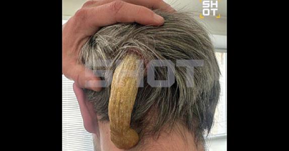 Rusiyada həkimlər kişinin başındakı böyük