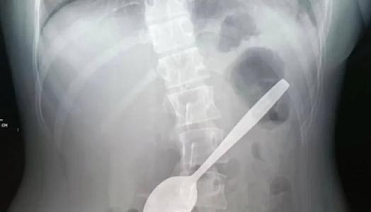 14 yaşlı qız təsadüfən qaşıq udub -