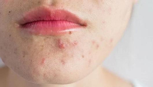 Sızanaqlara qarşı