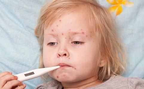 Həkim qızılca ilə bağlı valideynlərə çağırış edib: "Uşaqlar tez bir zamanda vaksinasiya olunmalıdır"