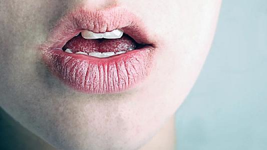 Ağız quruluğu 5 ciddi xəstəliyin