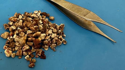 Dəhşətli hadisə: İki böyrəyindən