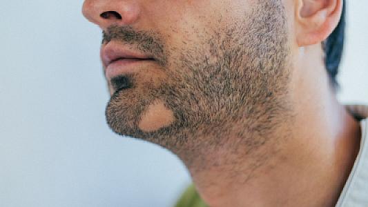 Mütəxəssislər kişilərdə sifilisin az bilinən, lakin