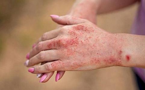 Şöbə müdiri: "Qızılca peyvəndləmə ilə idarə olunan yoluxucu xəstəliklər qrupuna daxildir"