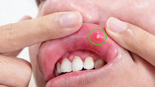 Ağız xərçənginin gözə çarpmayan əlamətləri –