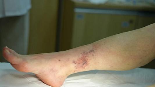 Varikoz damarları müalicə olunmadıqda