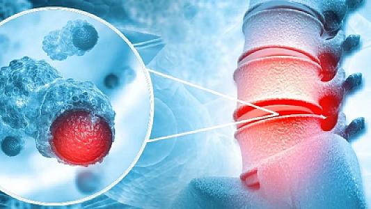 Həkimdən sümük şişi xəbərdarlığı:
