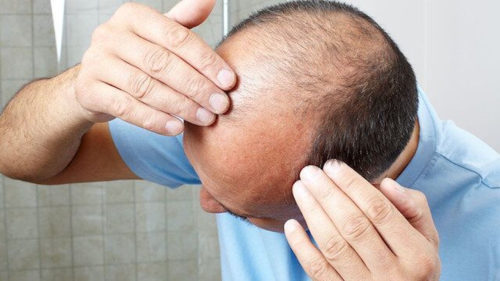 Yapon alimləri keçəlliklə mübarizənin ucuz və effektiv üsulunu