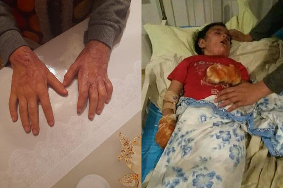 Dəhşətli faciədə əlləri yanan məktəblinin anası: “Qızım utandığından əllərini gizlədir” -