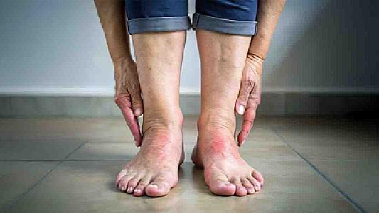 Dərmansız şəkildə ödemdən xilas olun: Səhərlər bu içkiləri için,