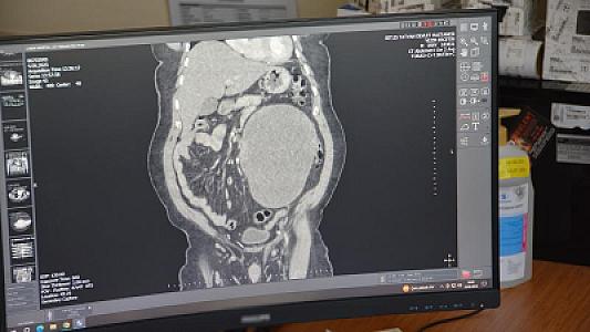 Qarın ağrısı ilə həkimə getdi, böyrəyindən