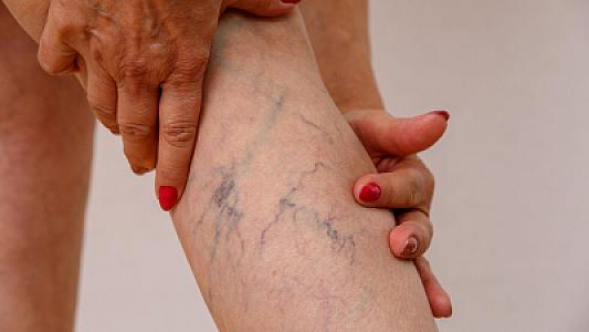 Həkim isti havalarda qan laxtalanma riskinə qarşı