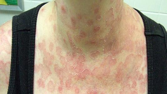 Baxımsız rosasea xəstəliyi qalıcı damar problemlərinə səbəb ola bilər -