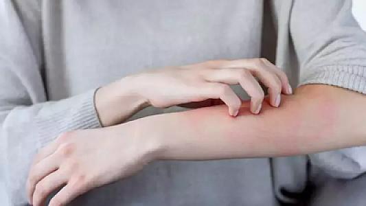 30 yaşlı qadın nadir dəri xəstəliyi səbəbindən