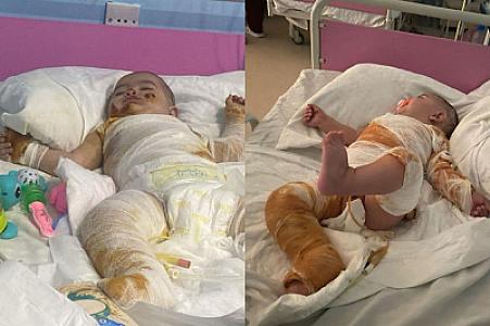 Bütün bədəni yanan körpənin anası fəryad edir: “Ağrılarına görə bütün günü ağlayır” - FOTO