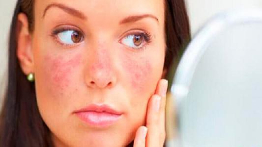 Kəpənək xəstəliyi nədir? -