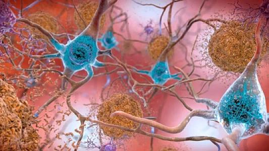 Alzheimerin müalicəsi üçün yeni ümid: