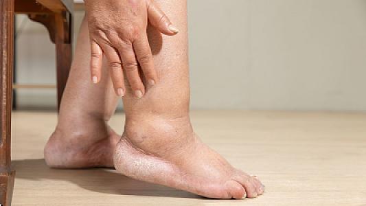 Terapevt yayda əllərin və ayaqların niyə şişdiyini və bununla necə
