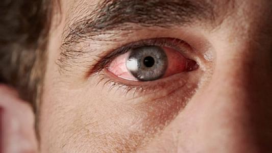 Gözlər sağlamlığın aynasıdır: Hansı əlamətlərə