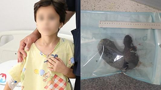 Bakıda öz saçlarını udan 9 yaşlı qızın mədəsindən