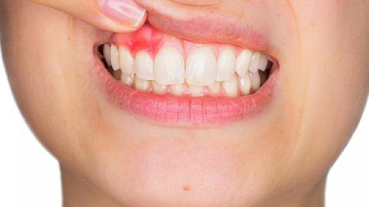 Diş əti qanayırsa, ürək də