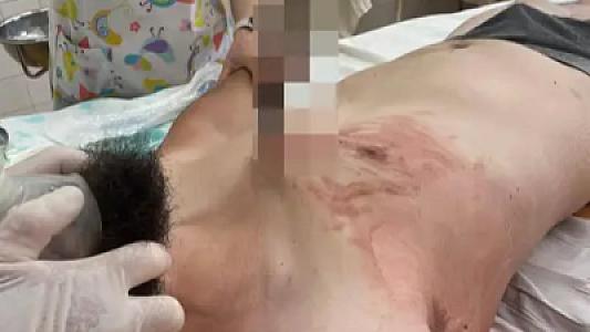 Həkimlər sinəsinə armatur batan fəhləni