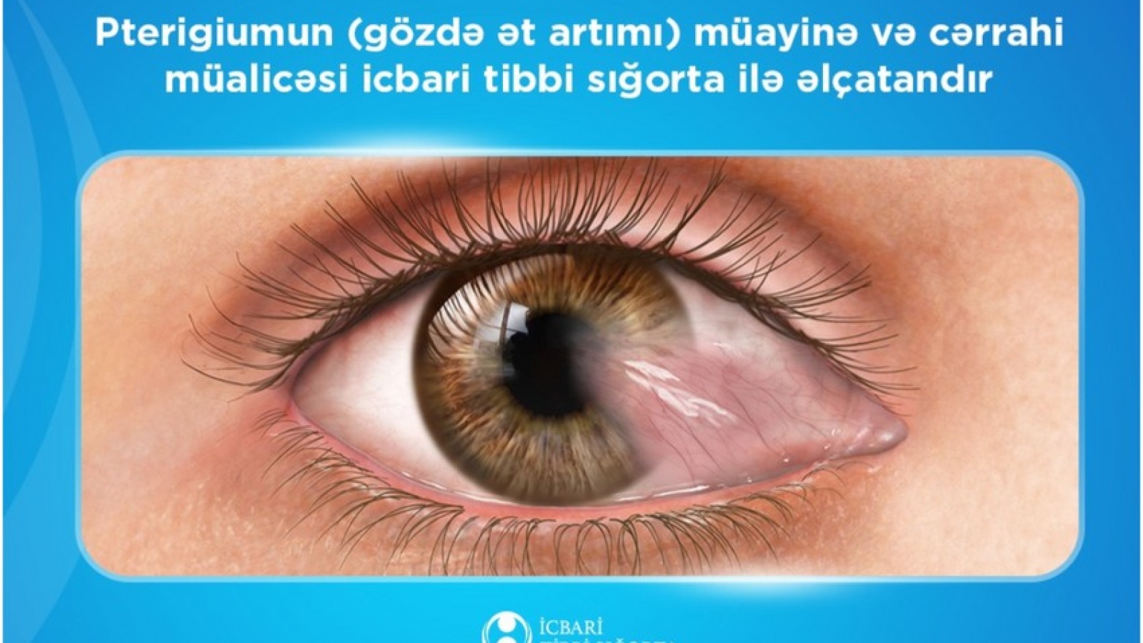 Gözdə ət artımının cərrahi müalicəsi