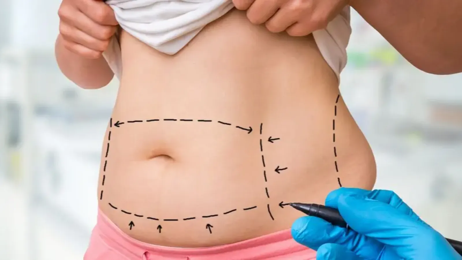 Abdominoplastika ilə bağlı ən çox verilən