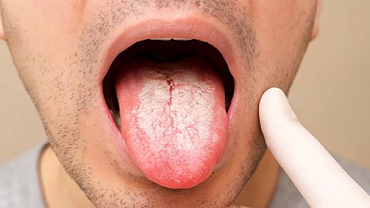 Dildə ağ örtüyün ciddi ağız xəstəliyinin