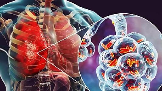 Ötən il Azərbaycanda pnevmoniyaya yoluxan