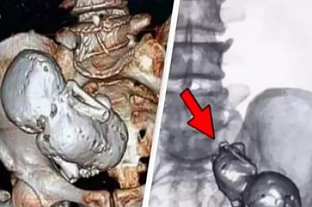 Tibbdə NADİR HADİSƏ: 73 yaşlı qadının bətnində