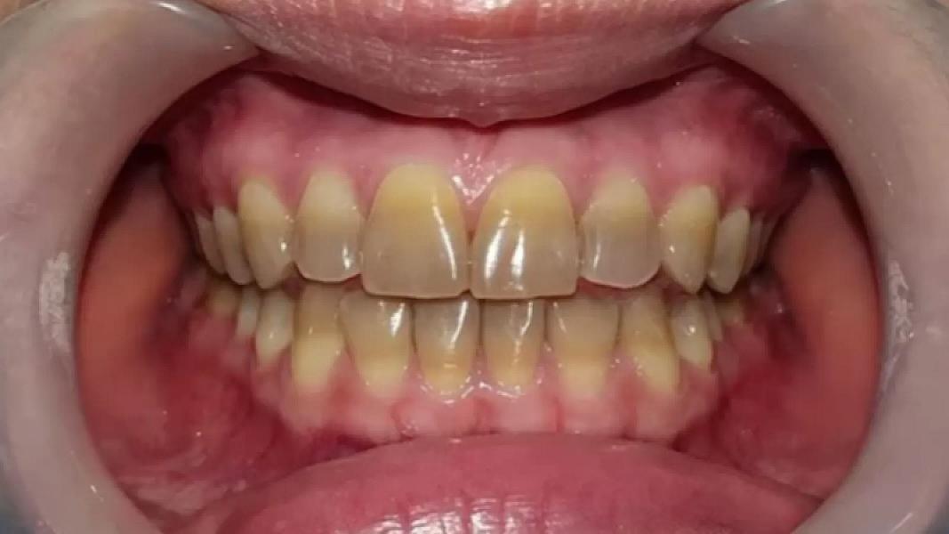 Dişlərinizin rəngi xəstəliyinizdən