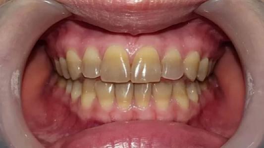 Dişlərinizin rəngi xəstəliyinizdən