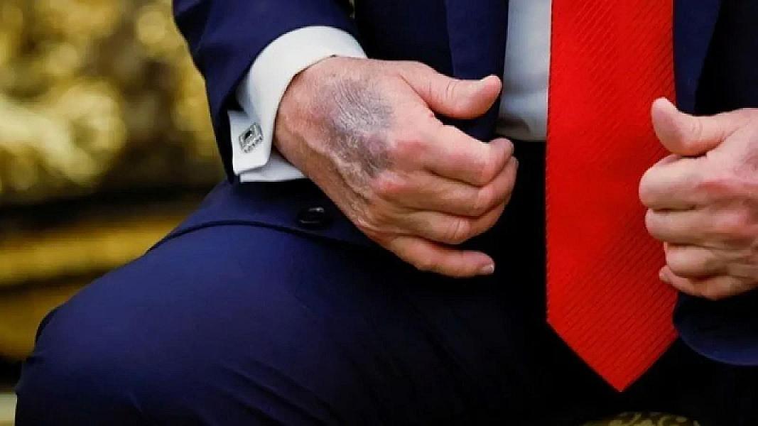 Trampın əli yenidən diqqət çəkdi –