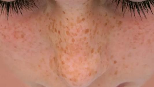 Yaydan sonra dəridə ləkələri artanların diqqətinə! -