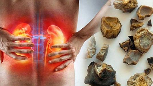 Alimlər böyrək daşlarına