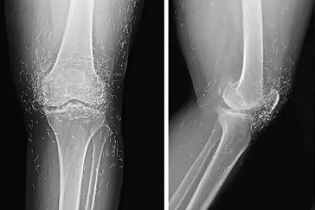 Cənubi Koreyada qadının dizlərindən