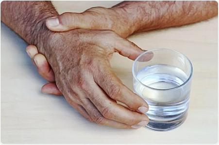 Parkinson xəstəliyinin İlk əlamətləri:
