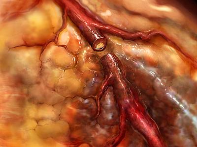 Arteriyalarda xolesterin yığılmasının ilk xəbərdarlığı: 