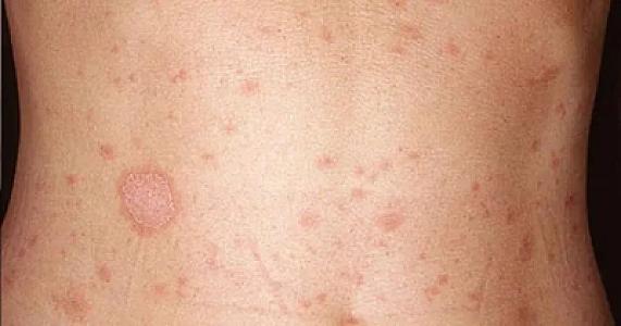 Bədəninizdə sürətlə yayılan qırmızı ləkələrdən 