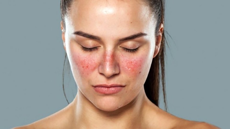Lupus xəstəliyi nədir?