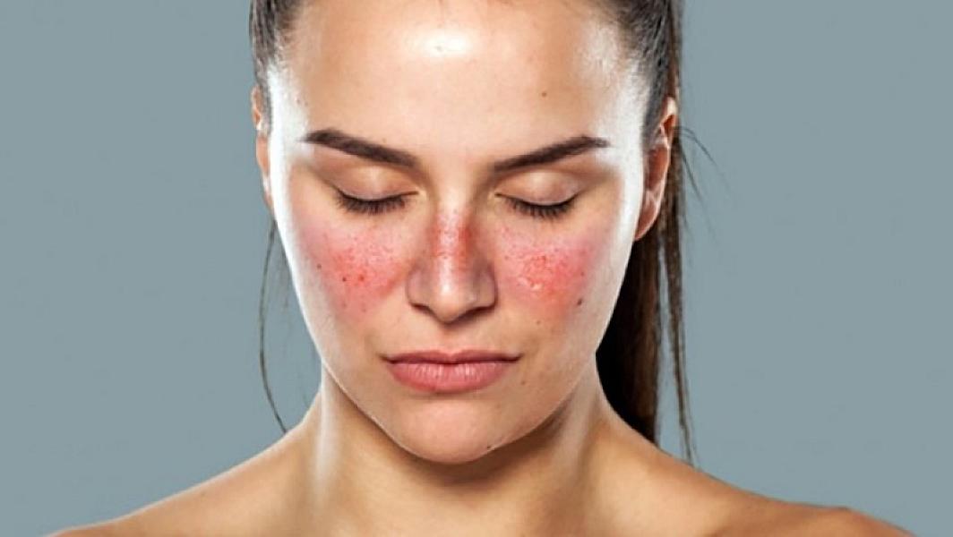 Lupus xəstəliyi nədir?