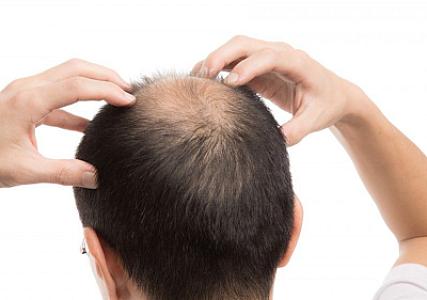 Keçəlliyə səbəb olan iki 