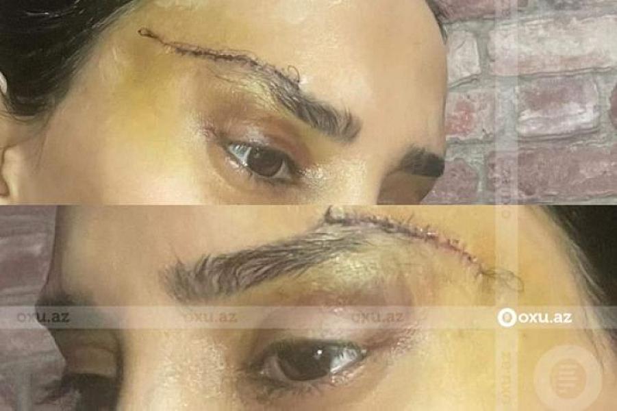 Bakıda estetik əməliyyatla bağlı ŞİKAYƏT: “10 min manat verməsən, səni biabır edəcəyəm”