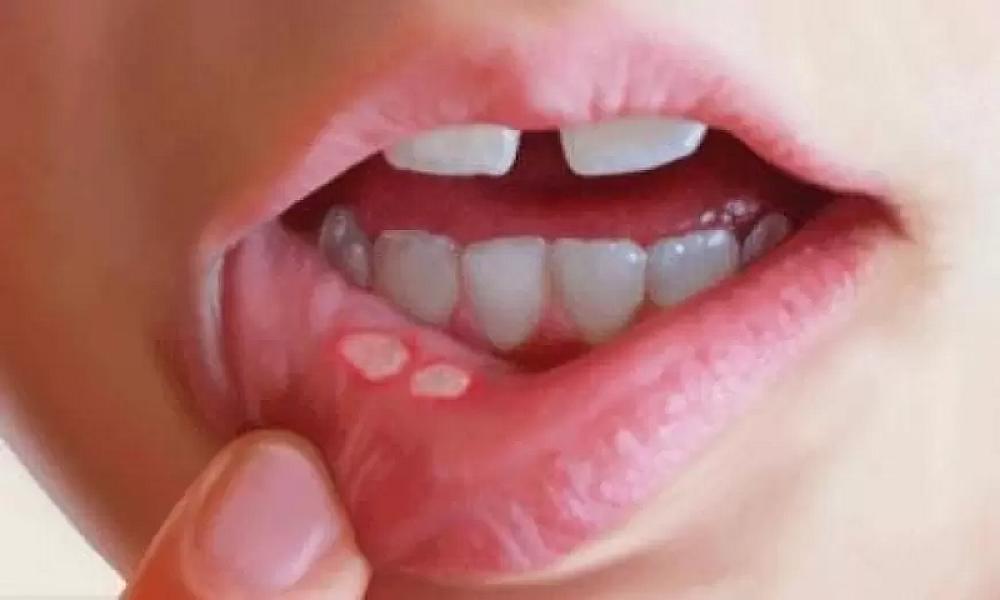 Stomatit: səbəbləri, əlamətləri və 