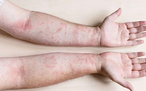 Ötən il Azərbaycanda neçə nəfər qızılcaya yoluxub?