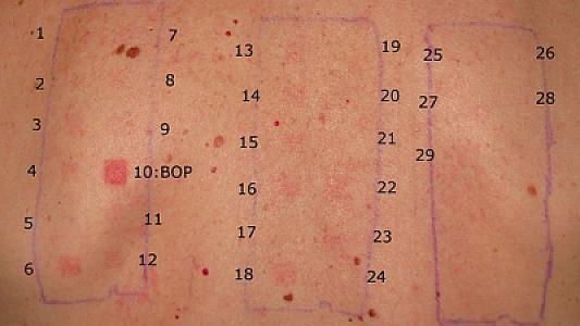 Bir dərmana qarşı allergiyam olub-olmadığını 