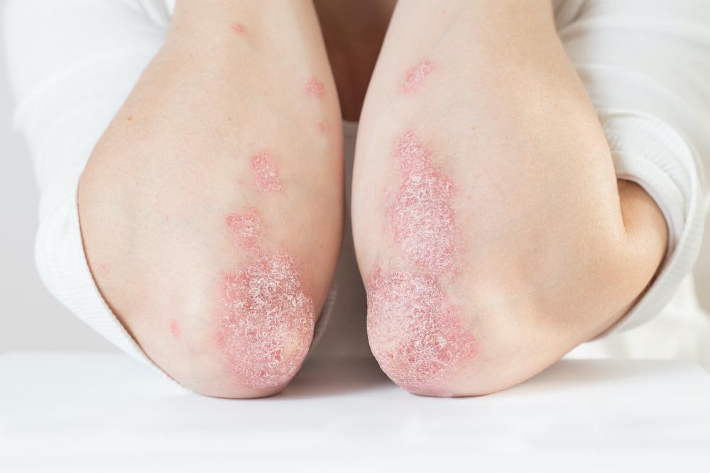 Psoriaz nədir və necə müalicə olunur? 